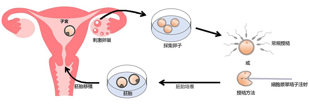 谁需要IVF治疗？