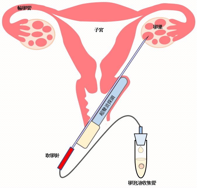 二、采集卵子(取卵程序)