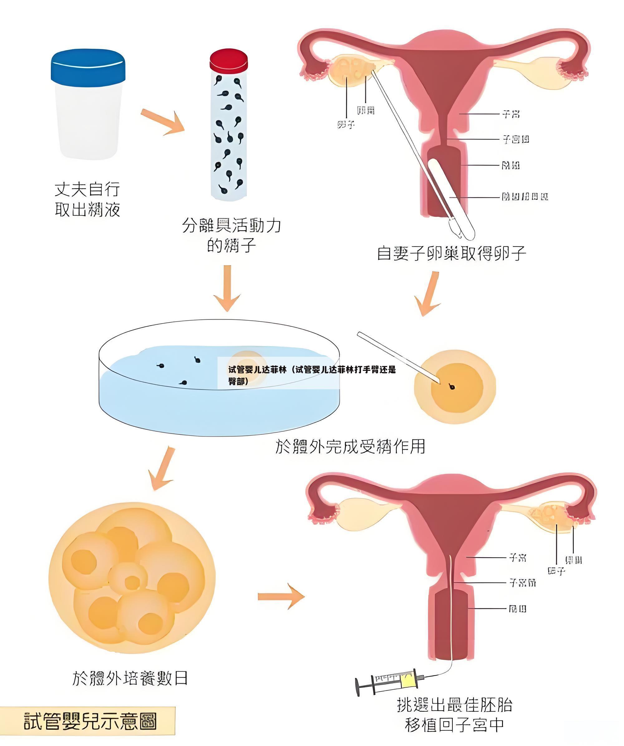 试管婴儿达菲林（试管婴儿达菲林打手臂还是臀部）